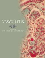 Vasculitis