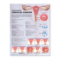 Understanding Cervical Cancer Anatomical Chart