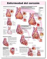 Heart Disease Anatomical Chart in Spanish (Enfermedad Del Corazón)