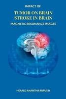 Impact of Tumor on Brain Stroke in Brain Magnetic Resonance Images