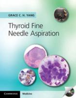 Thyroid Fine Needle Aspiration With CD Extra