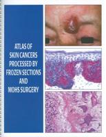 Atlas Of Skin Cancers Processed By Frozen Sections And Mohs Surgery