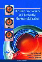 The Blue Line Incision and Refractive Phacoemulsification