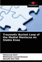 Traumatic Bucket Loop of the Medial Meniscus on Stable Knee