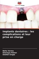 Implants Dentaires