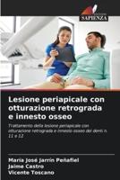 Lesione Periapicale Con Otturazione Retrograda E Innesto Osseo