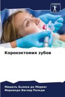 Коронэктомия Зубов