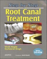 Step by Step: Root Canal Treatment