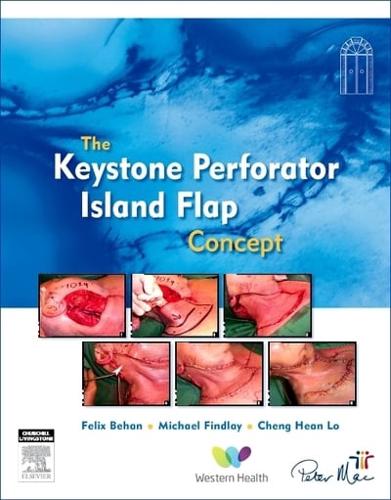 The Keystone Island Flap Concept in Reconstructive Surgery