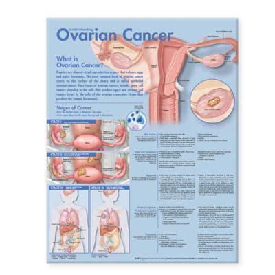 Understanding Ovarian Cancer Anatomical Chart