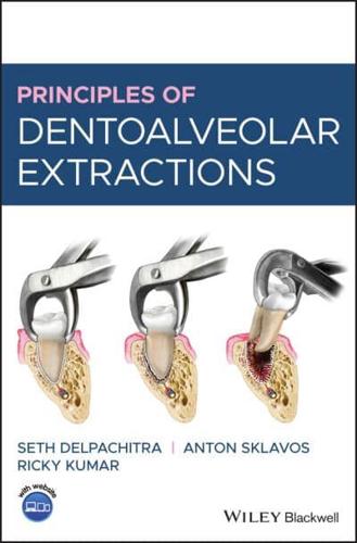 Principles of Dentoalveolar Extractions