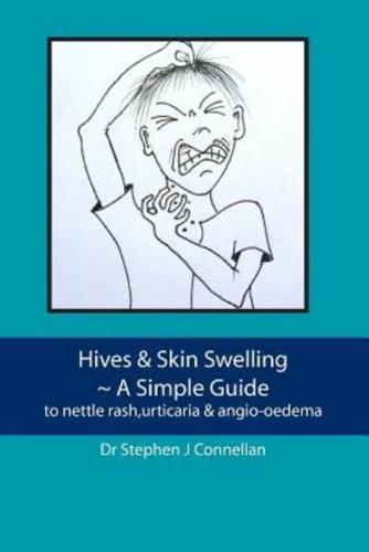 Hives & Skin Swelling a Simple Guide