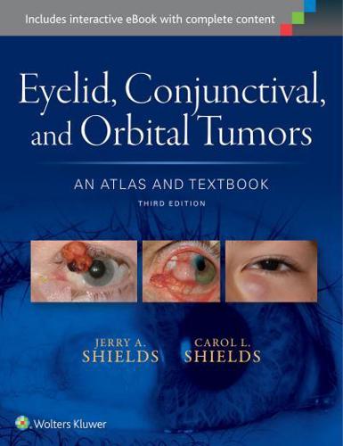 Eyelid, Conjunctival, and Orbital Tumors